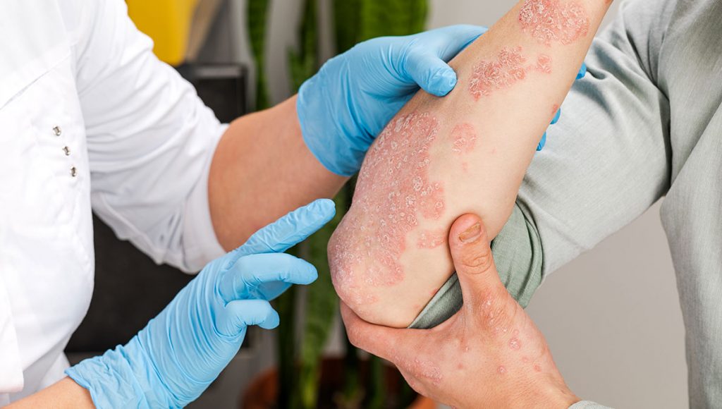 Cannabis bei Neurodermitis und Psoriasis